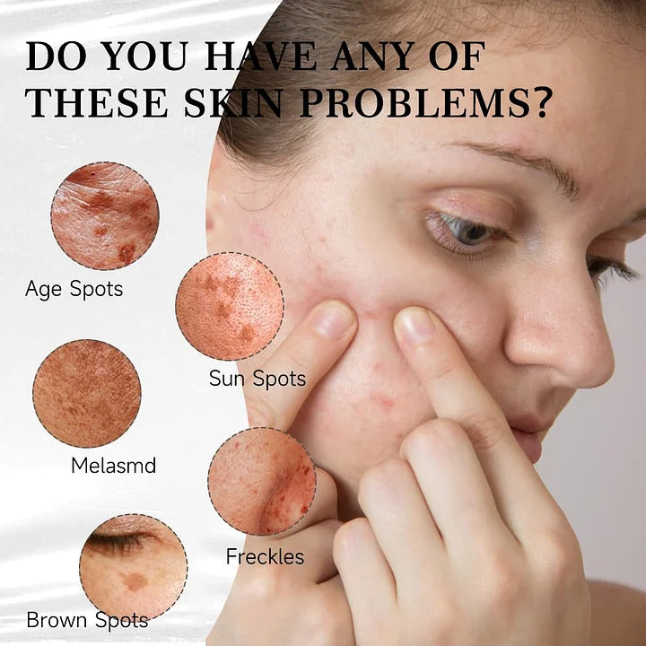 Aobenz dark spot remover serum