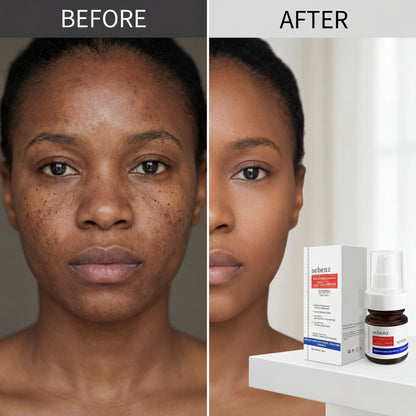 Aobenz dark spot remover serum